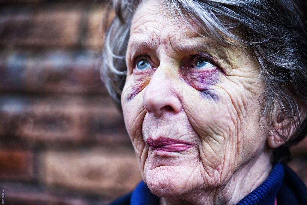 Seniorin mit blauen Flecken im gesicht